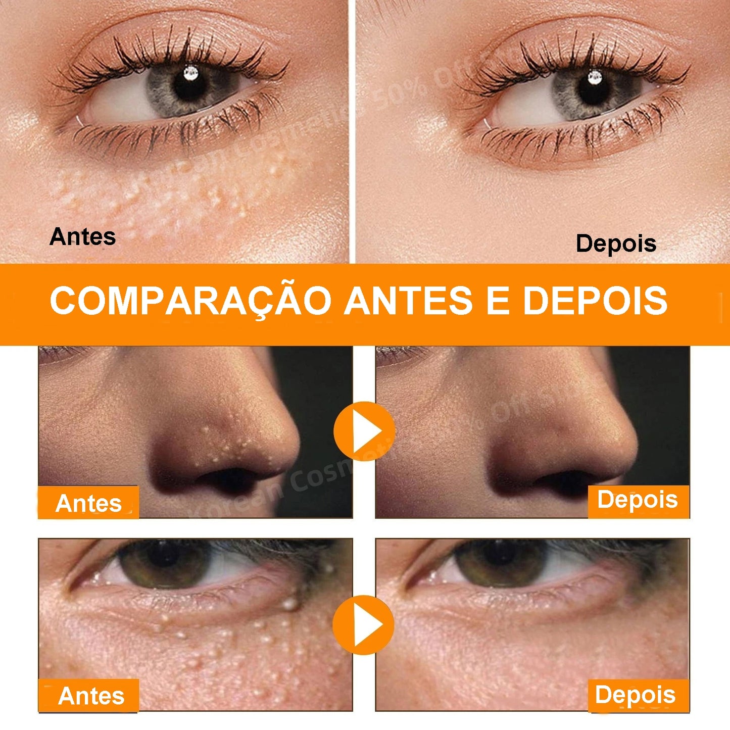 Soro para Remoção de Grânulos de Gordura