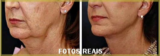 Linha de Proteína de Colágeno para Lifting Caseiro